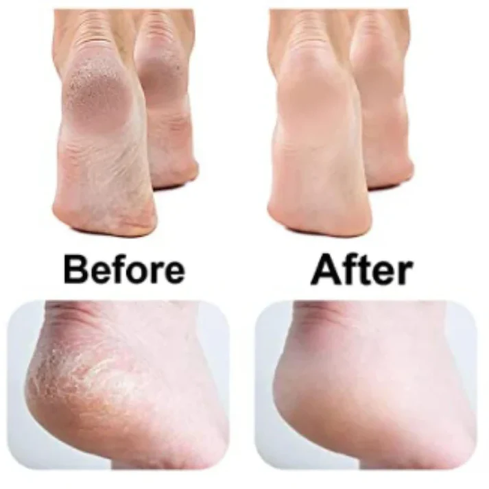 Electric Pedicure Foot Callus Grinder USB Charging Feet Care Dead Skin Remover Machine Foot File Callus Remover Cordless Foot File Easy Grip Adjustable - Image 5